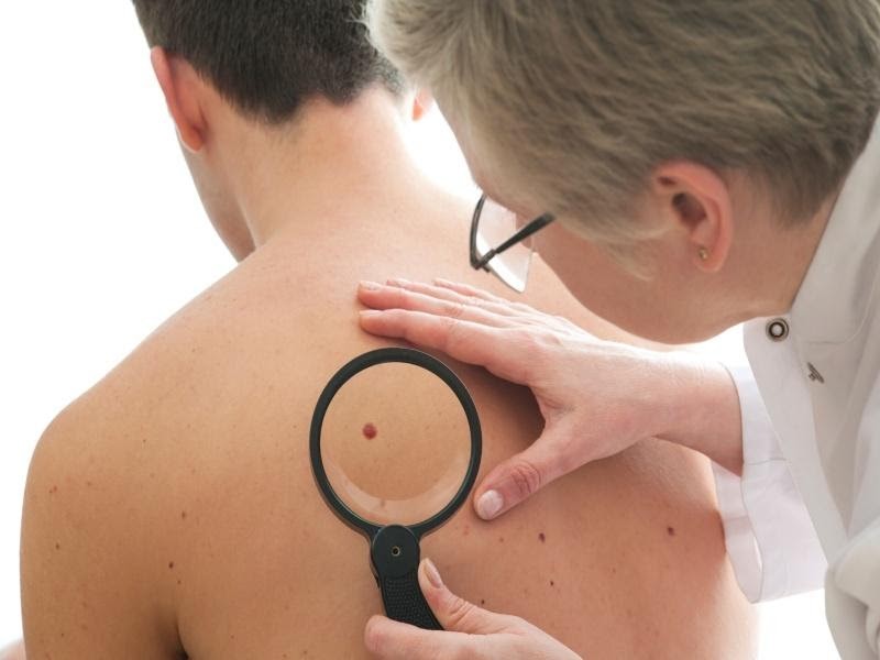 Úc là quốc gia có tỷ lệ mắc ung thư da cao nhất trên thế giới